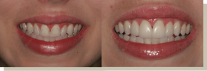 Direct Bonding Front Teeth