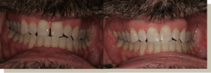 Closing front tooth gap with bonding