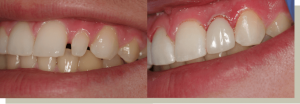 Direct bonding on lateral tooth